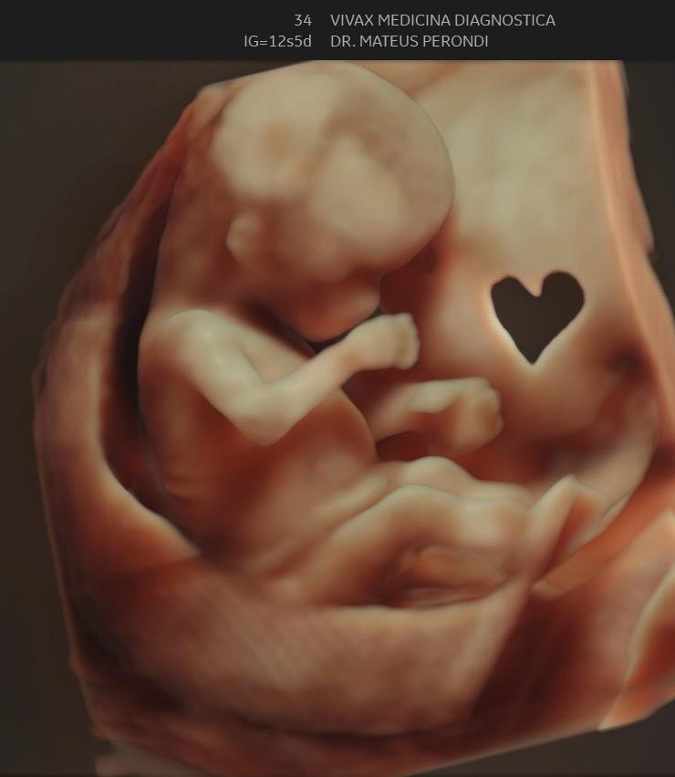 Imagem em 3D de feto com 12 semanas e 5 dias obtida no morfológico de 1º trimestre — Viváx Medicina Diagnóstica