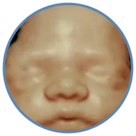 Imagem em 3D do rosto fetal na avaliação de crescimento fetal — Viváx Medicina Diagnóstica