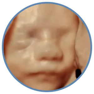 Imagem em 3D do rosto fetal obtida em ultrassonografia na Viváx Medicina Diagnóstica